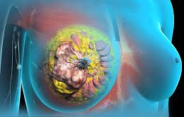 دکتر نرگس واسعی جراحی سرطان سینه -دکتر نرگس واسعی جراح عمومی