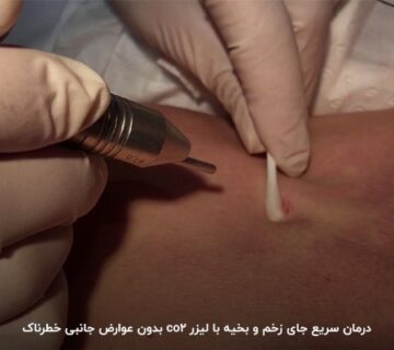 درمان اسکار و سوختگی