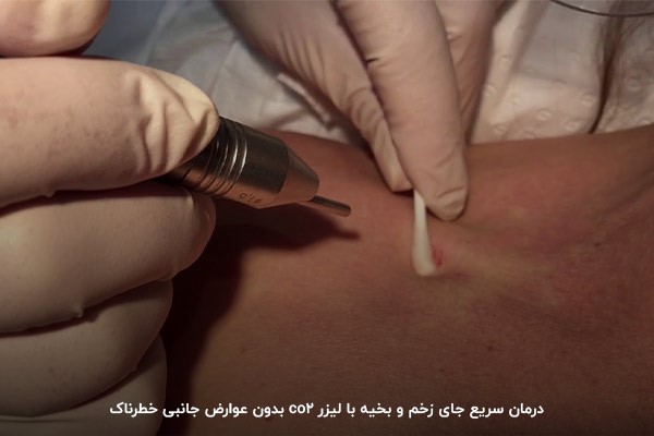 درمان اسکار و سوختگی